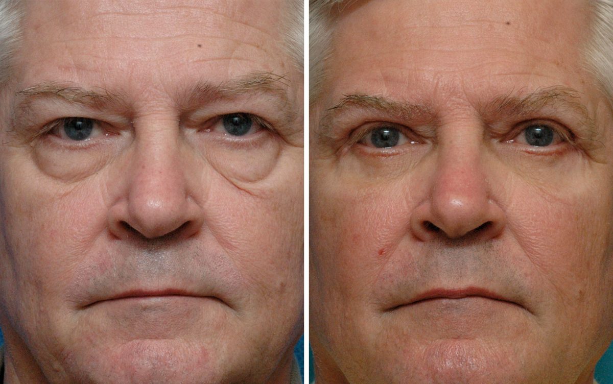 blefaroplastia-patricia-martinez-1200x752.jpg