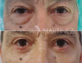 blefaroplastia