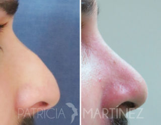 rinoplastia en hombres