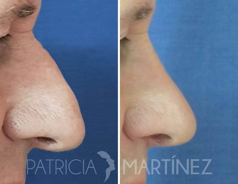 rinoplastia3