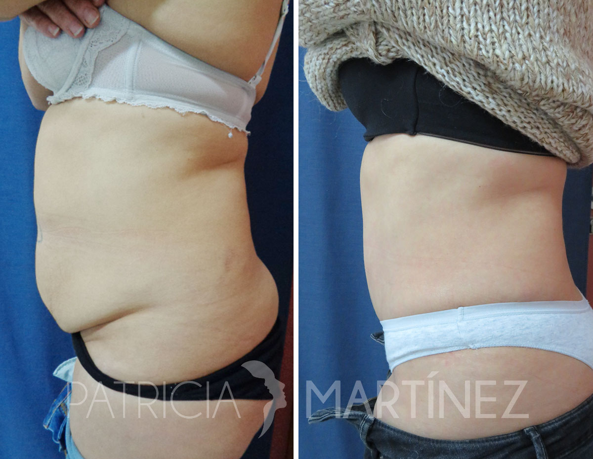 abdominoplastia1