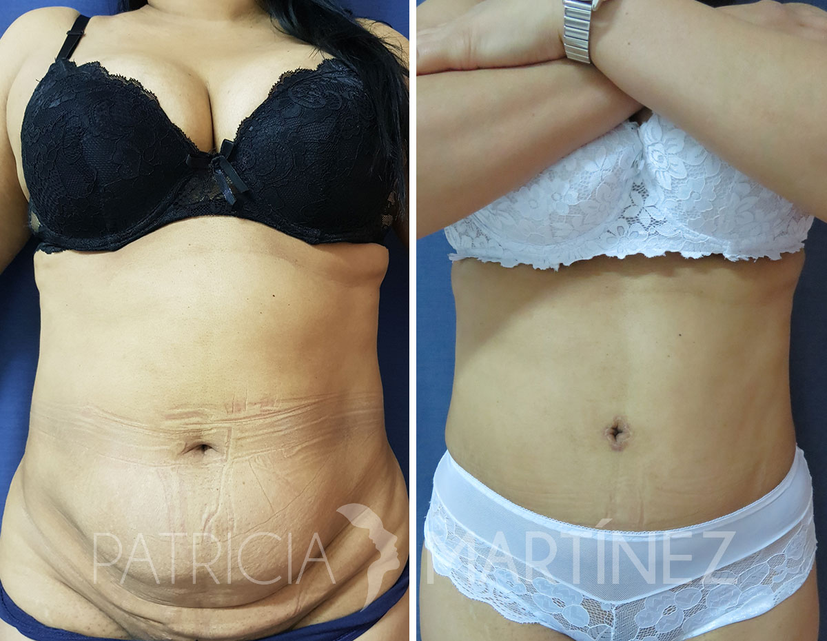 abdominoplastia2