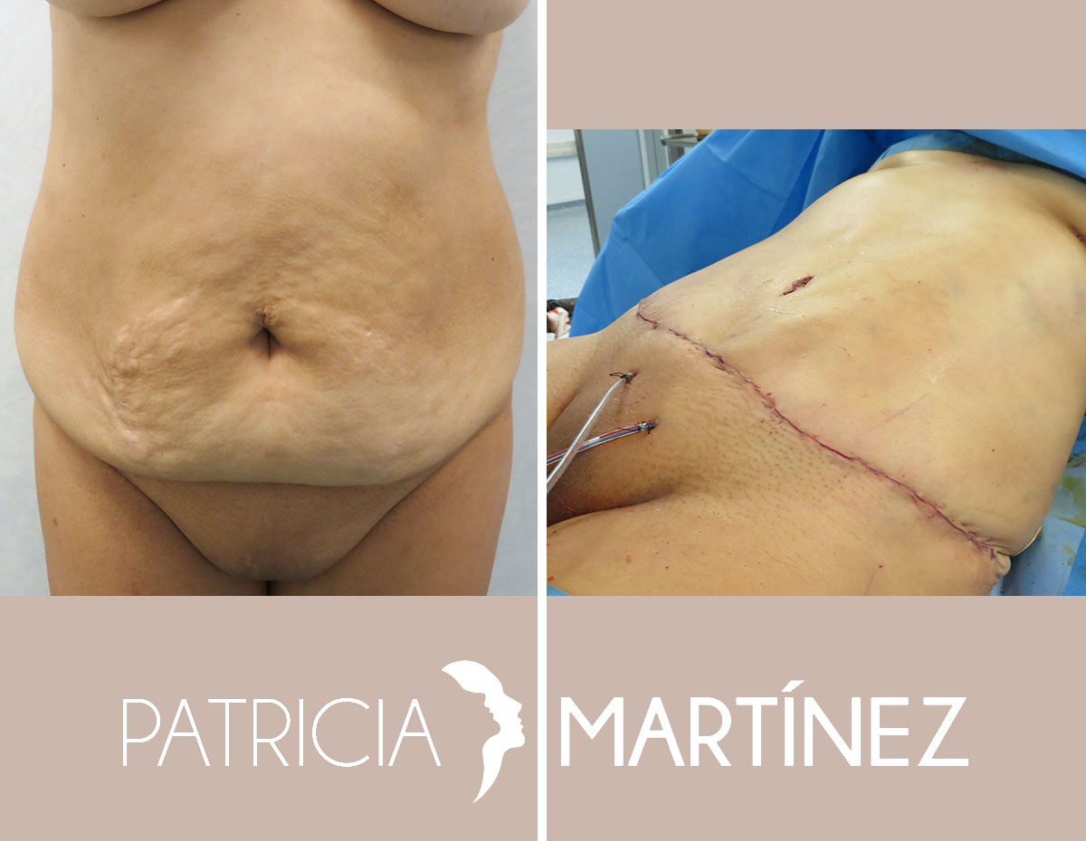 abdominoplastia3