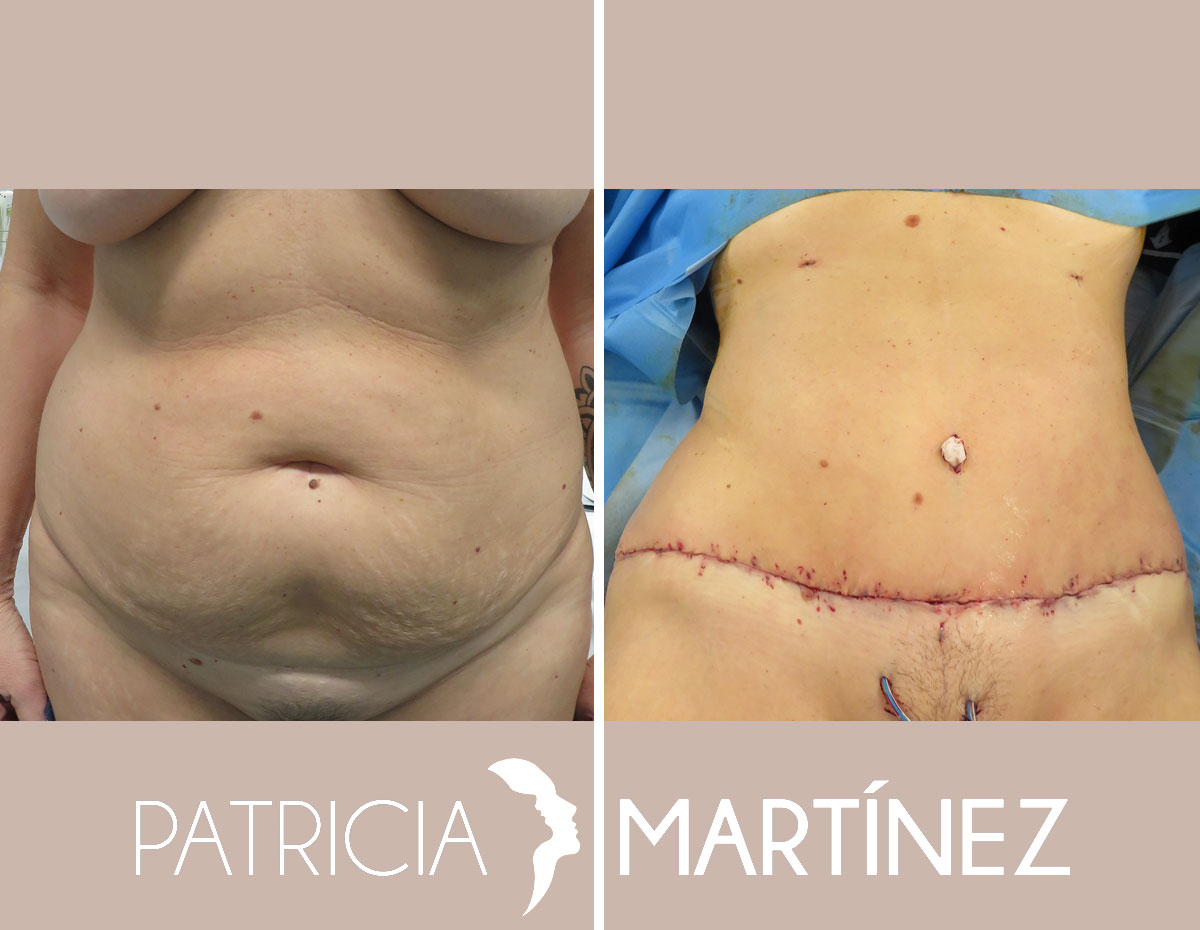 abdominoplastia4