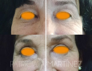 blefaroplastia antes-después
