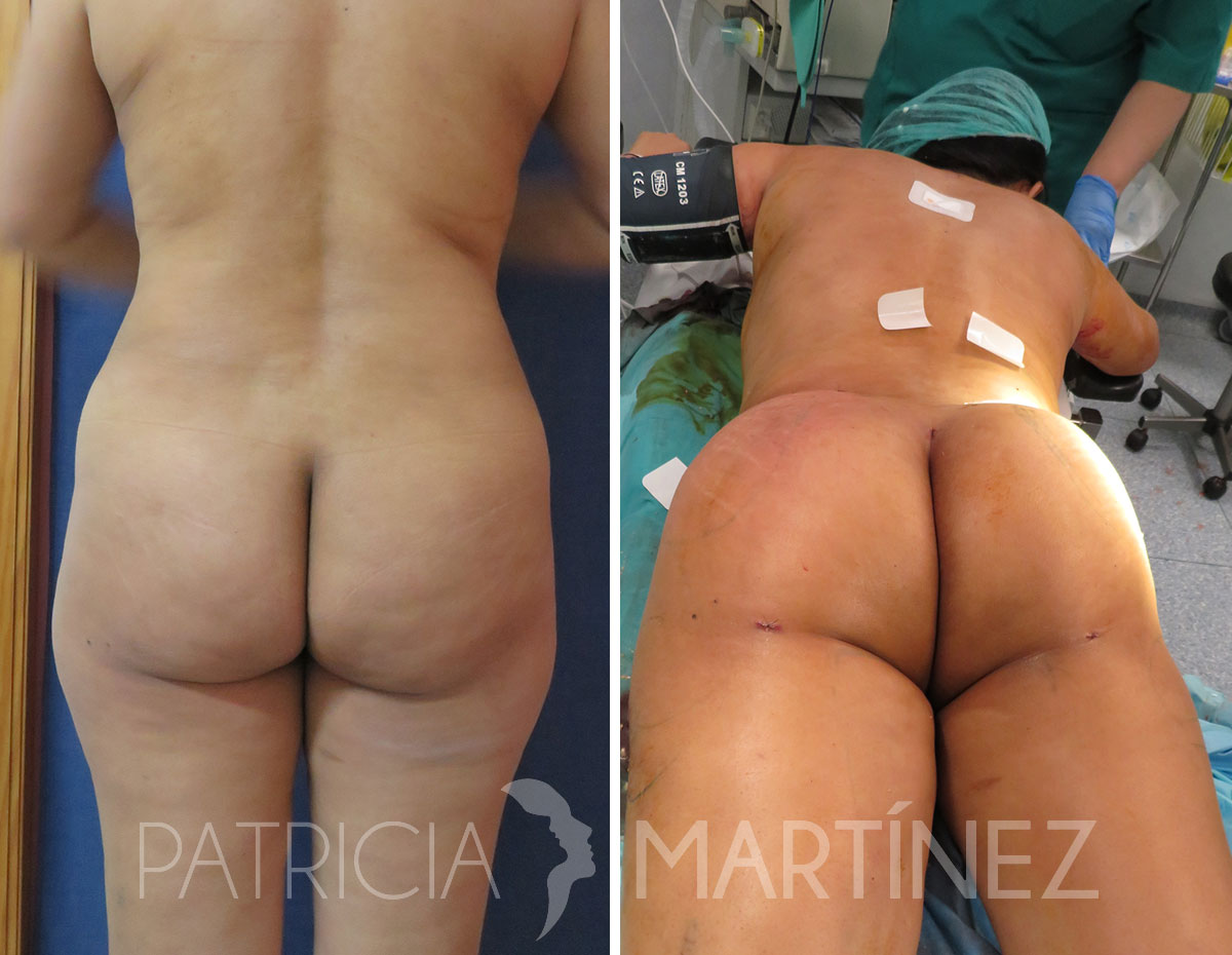 gluteoplastia1