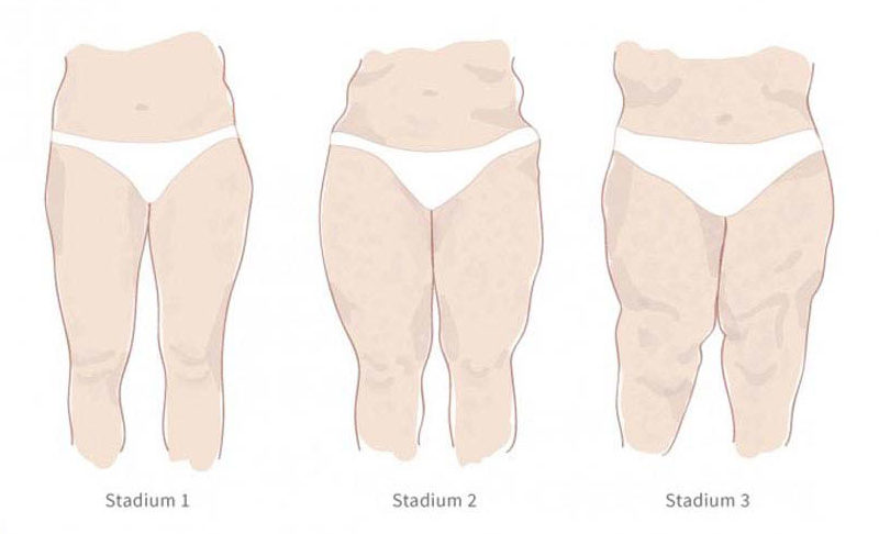 TENGO LIPEDEMA. ¿QUÉ MEDIAS DEBO - clinicaconstanza