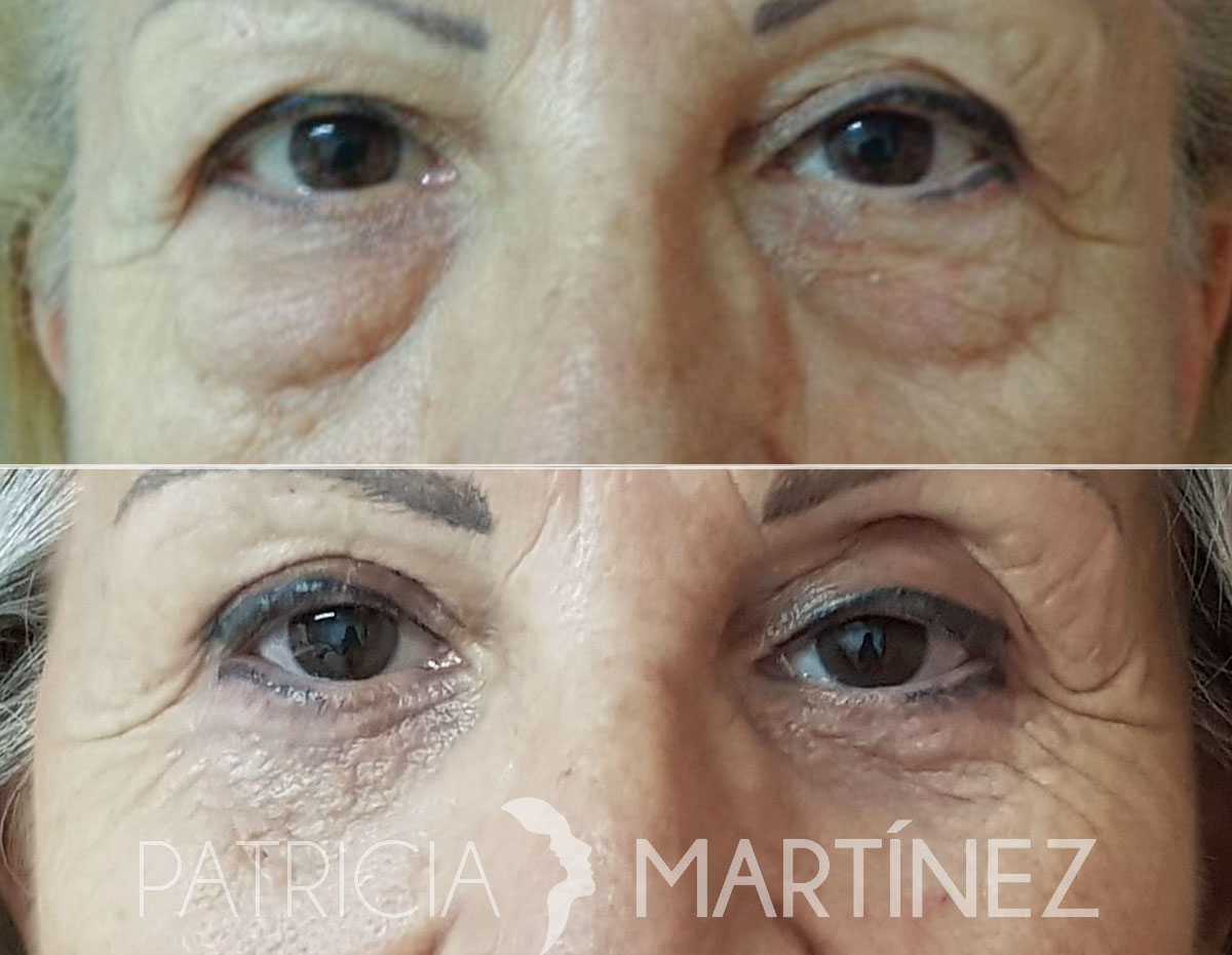 blefaroplastia01r