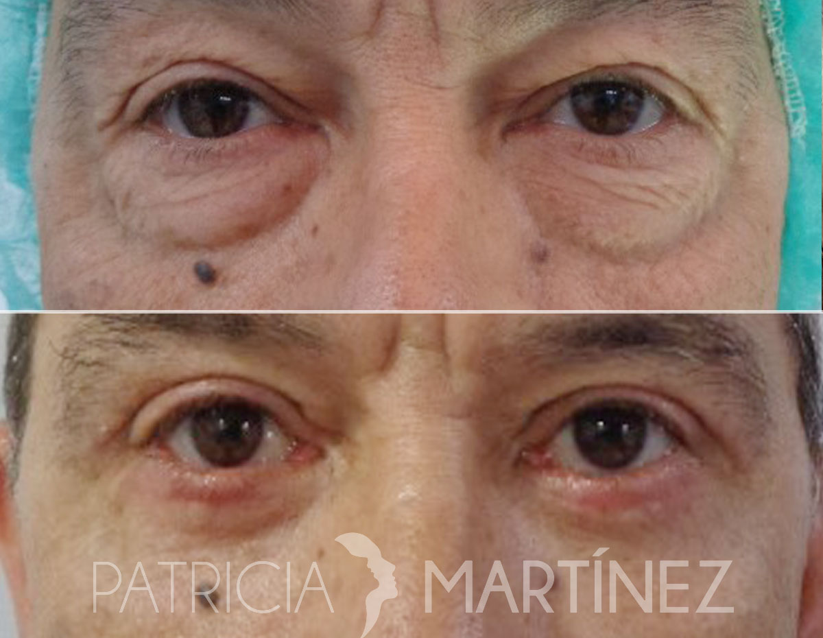 blefaroplastia02r