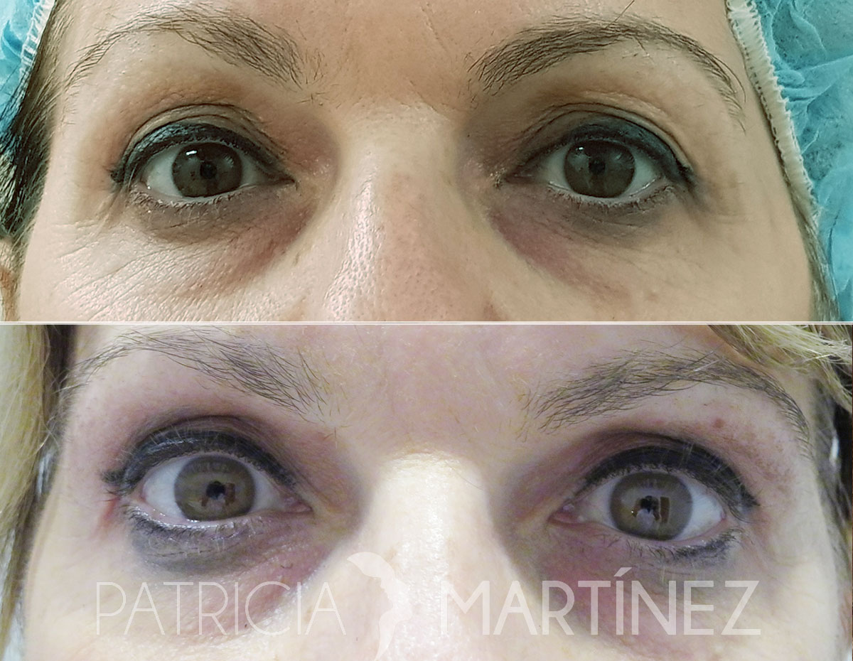 blefaroplastia03r