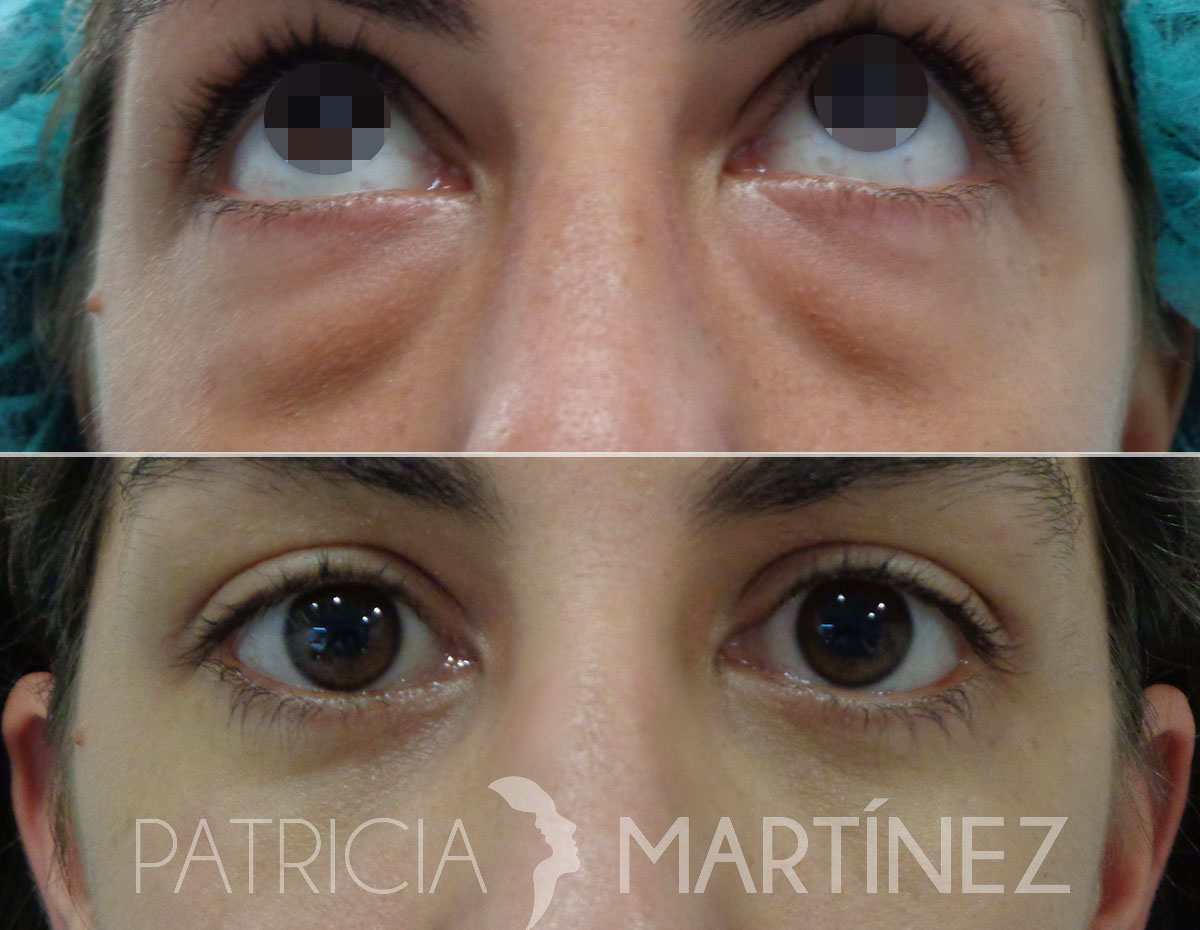 blefaroplastia04r