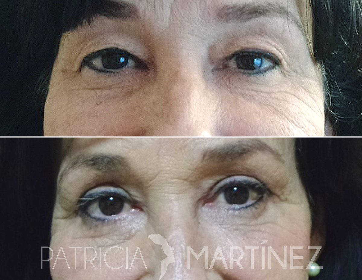 blefaroplastia05r