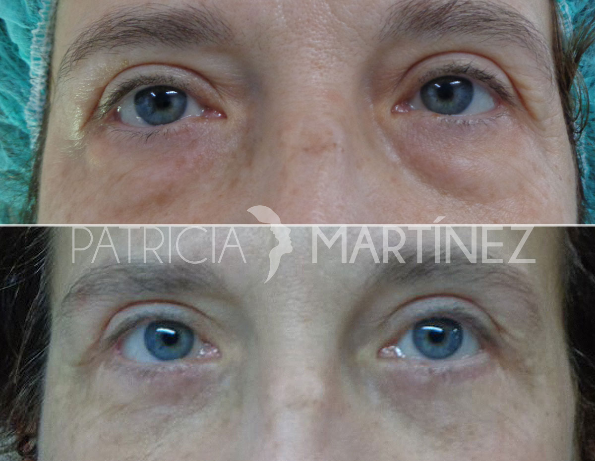 blefaroplastia06r