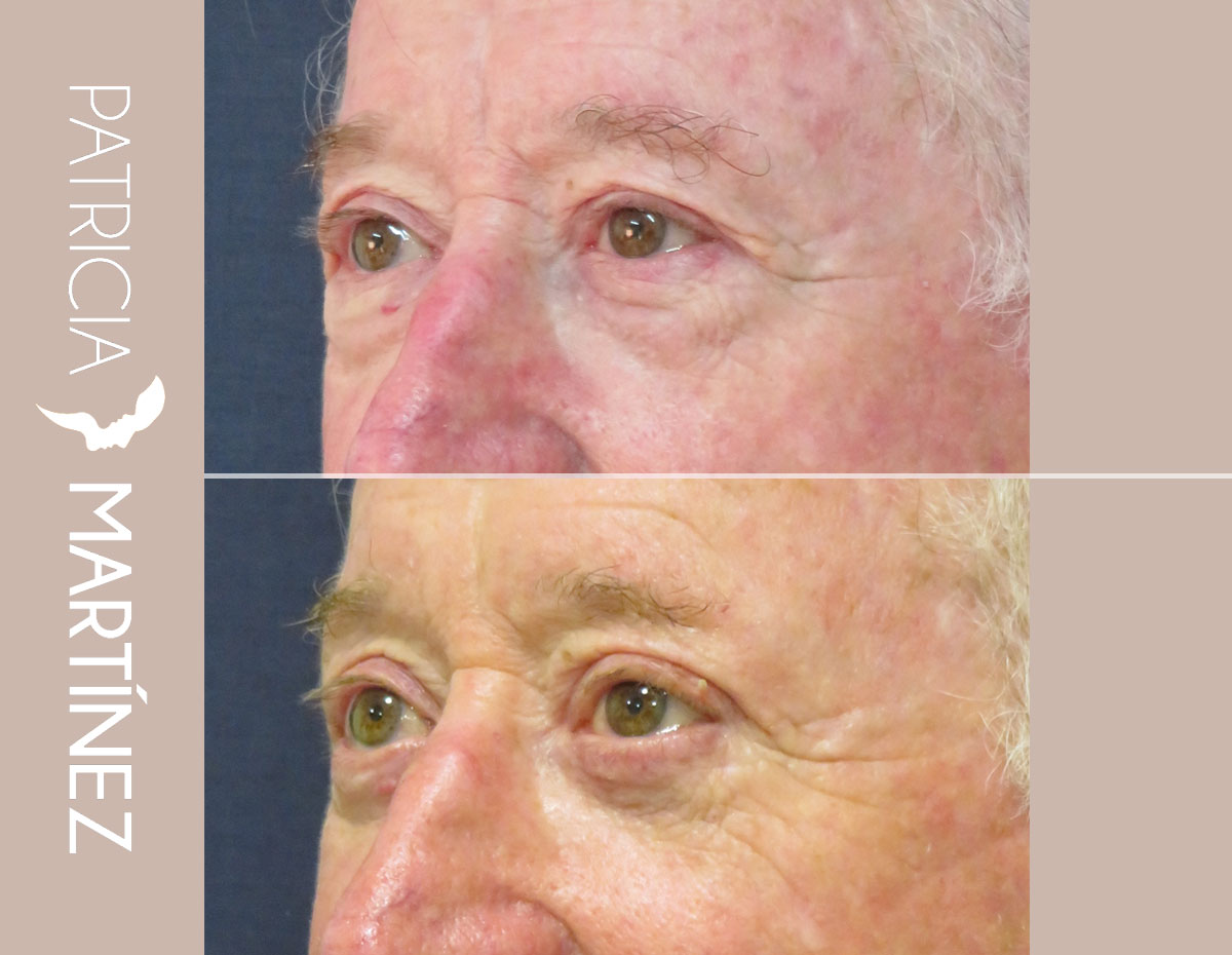 blefaroplastia07r