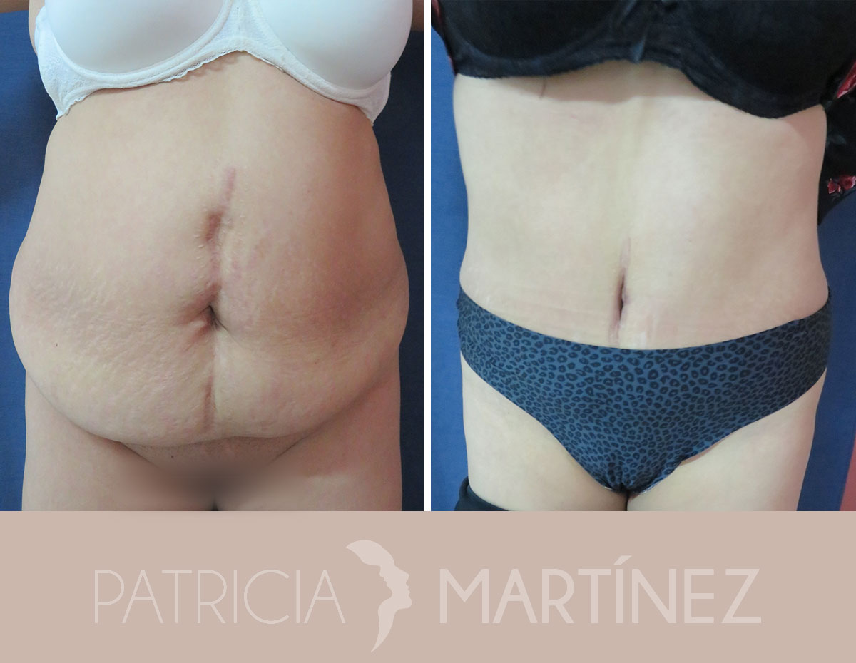 antes-despues-abdominoplastia-05