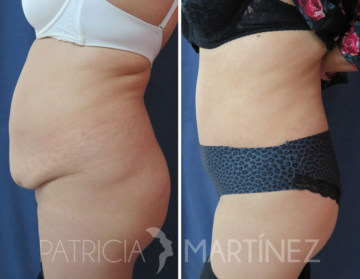 antes-despues-abdominoplastia-06