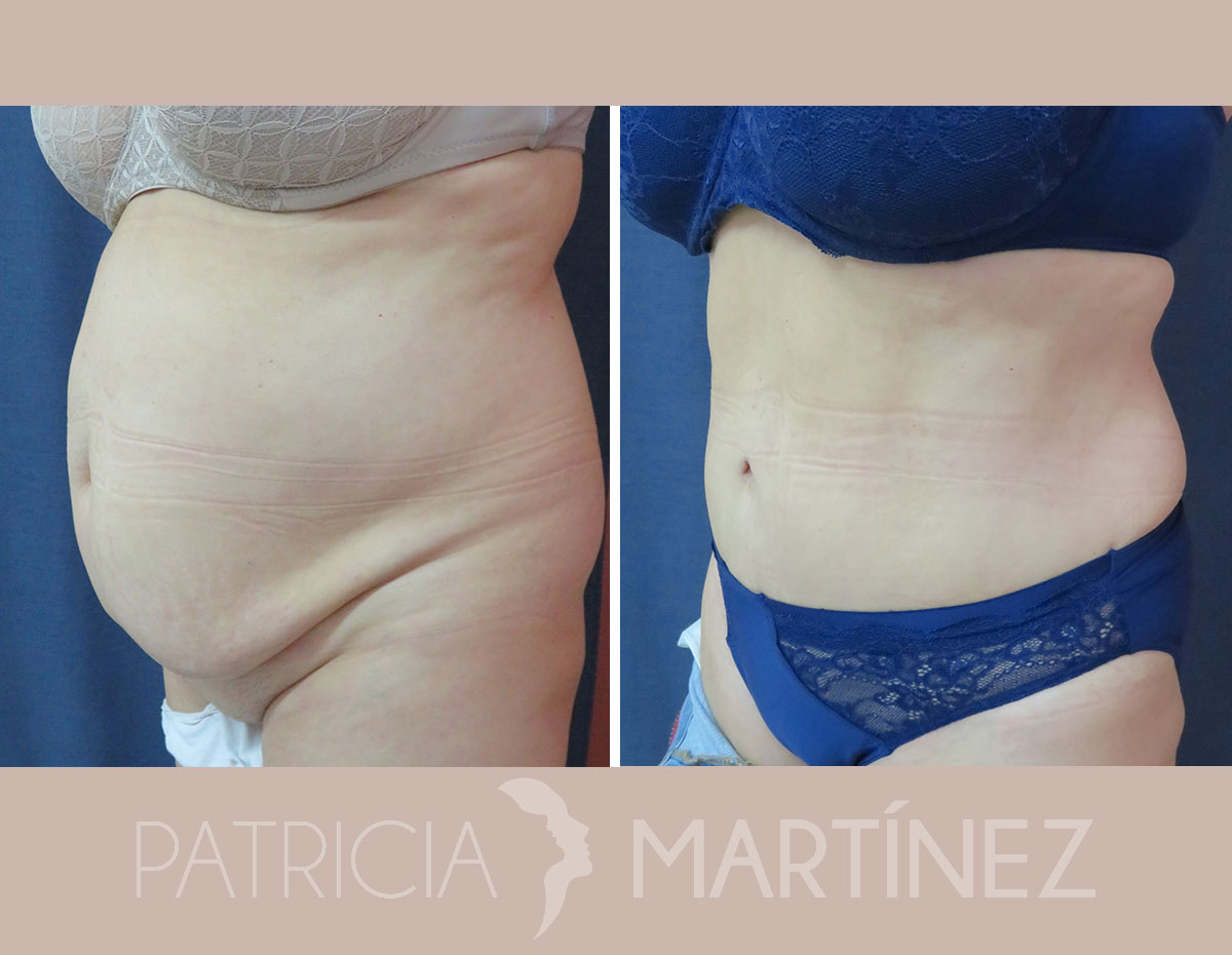 antes-despues-abdominoplastia-07