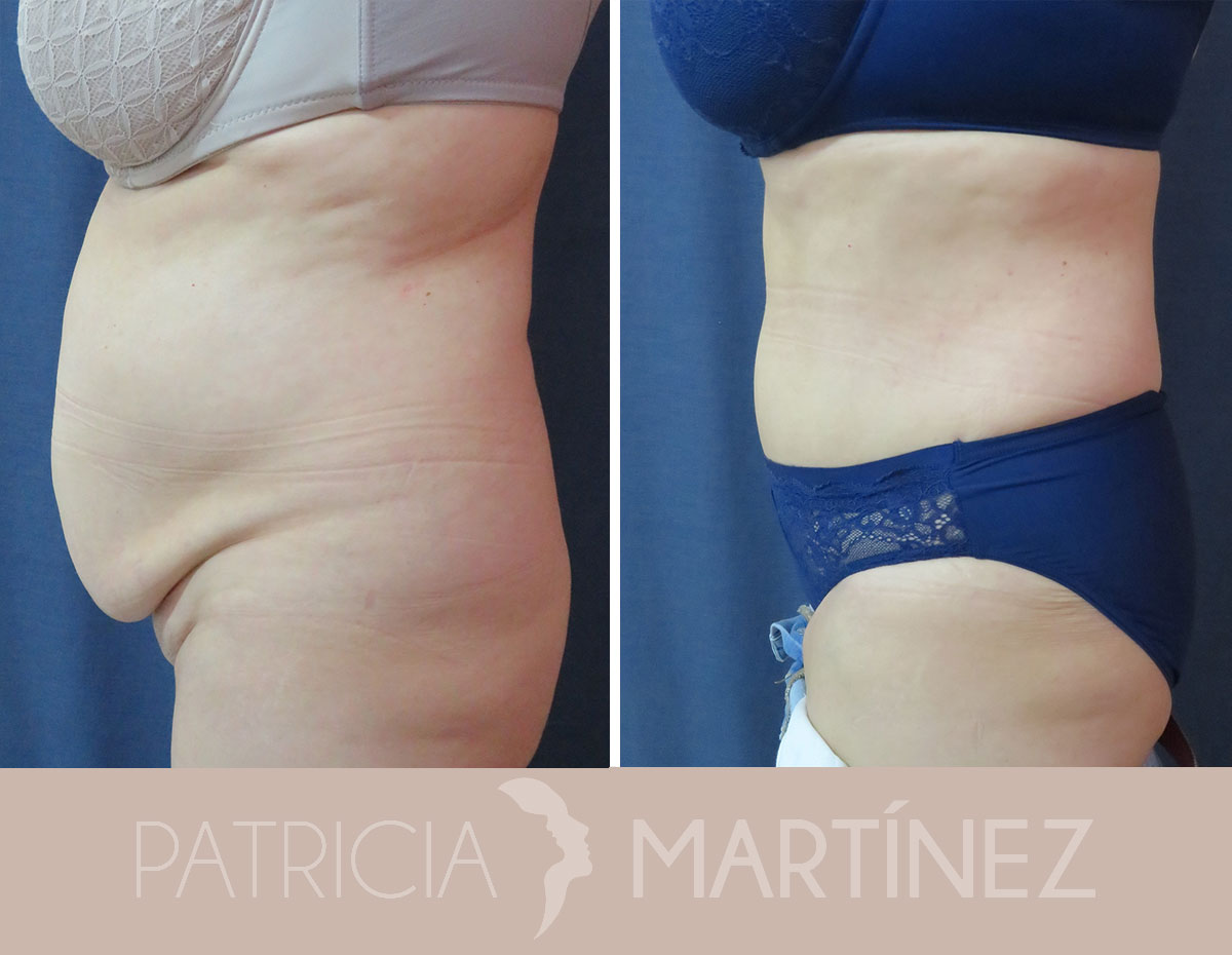 antes-despues-abdominoplastia-08