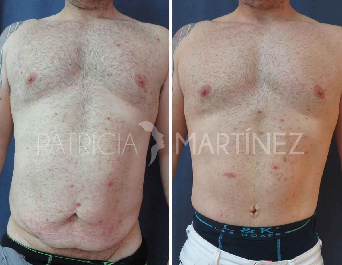 antes-despues-abdominoplastia-09