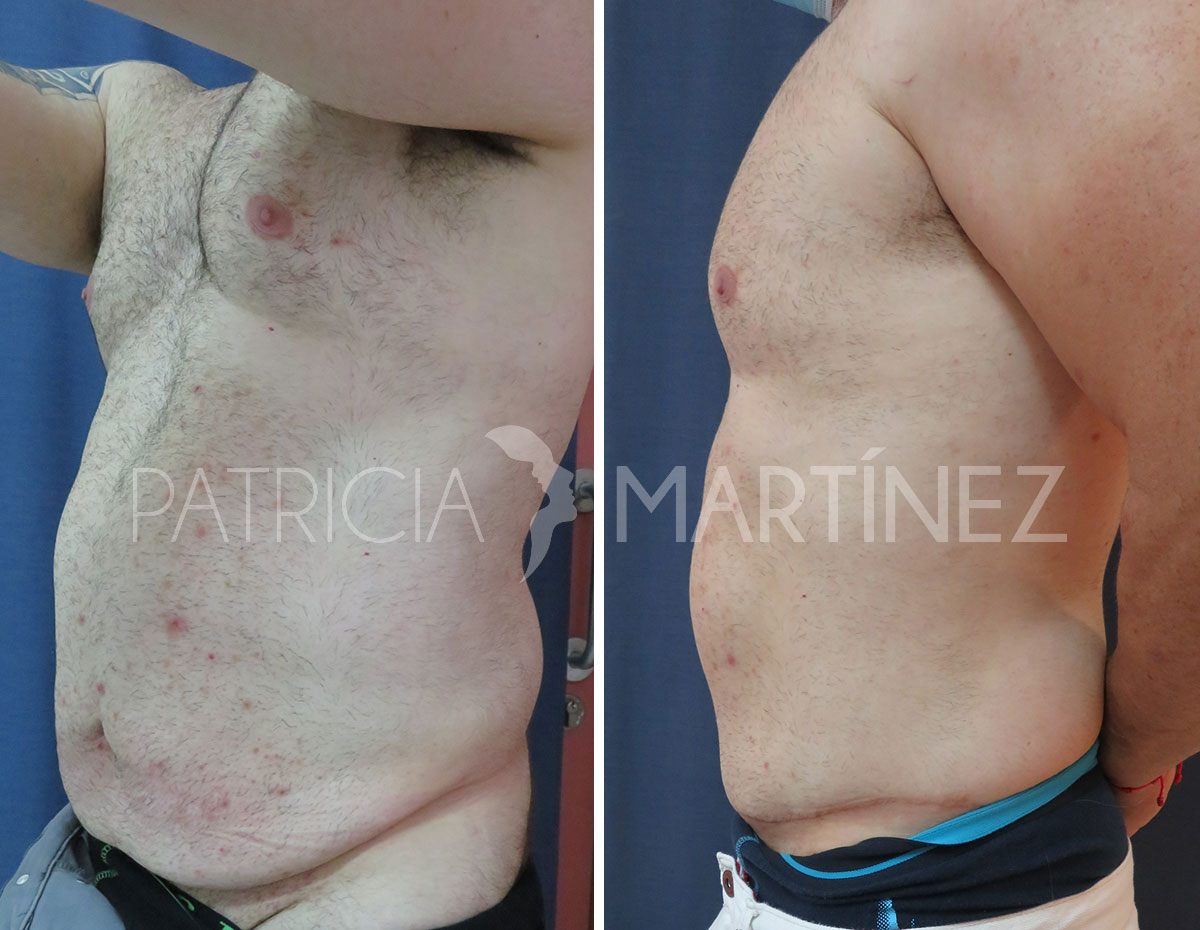 antes-despues-abdominoplastia-10