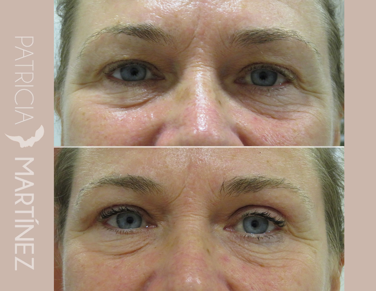 antes-despues-blefaroplastia-08