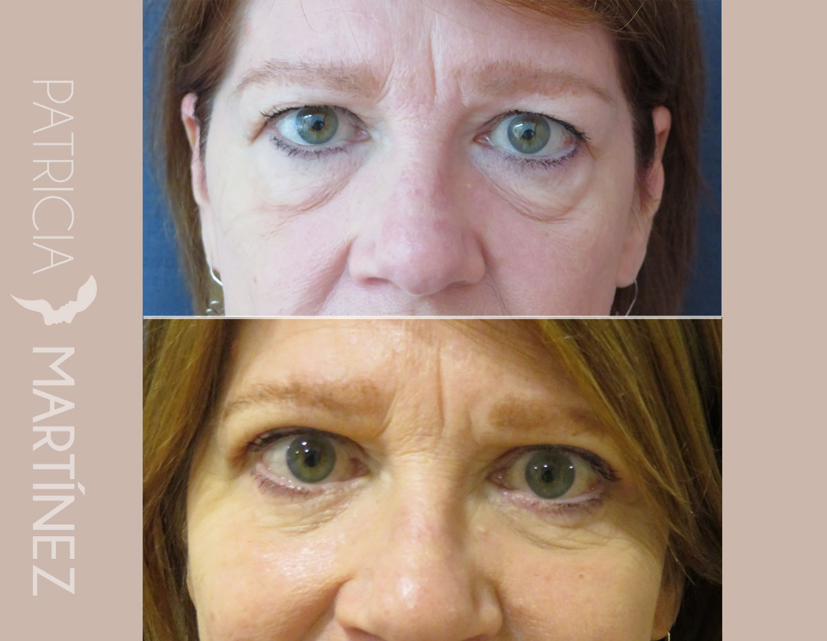 antes-despues-blefaroplastia-09