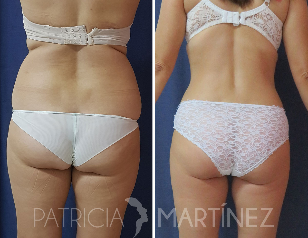 antes-despues-liposuccion-06