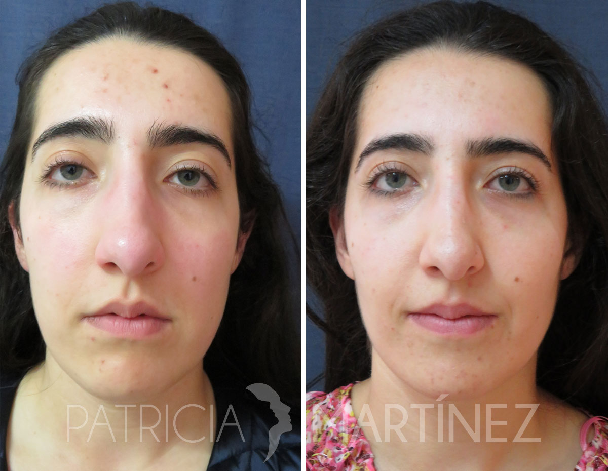 antes-despues-perfiloplastia-01