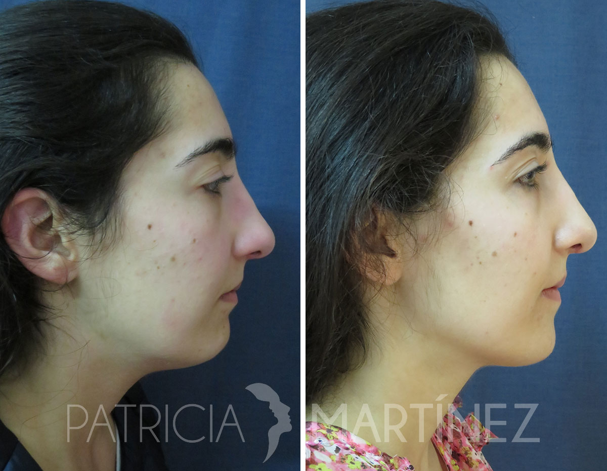 antes-despues-perfiloplastia-02