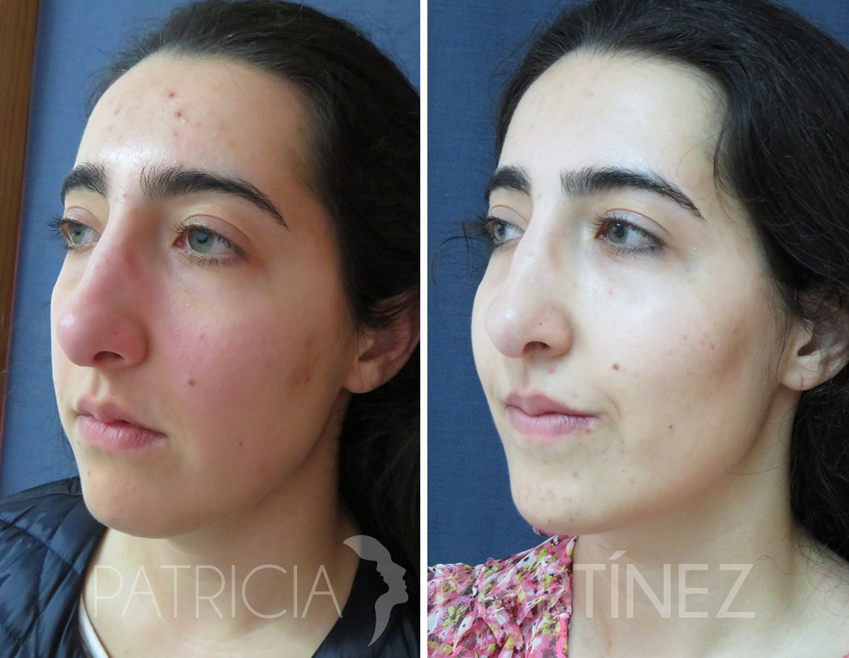 antes-despues-perfiloplastia-03