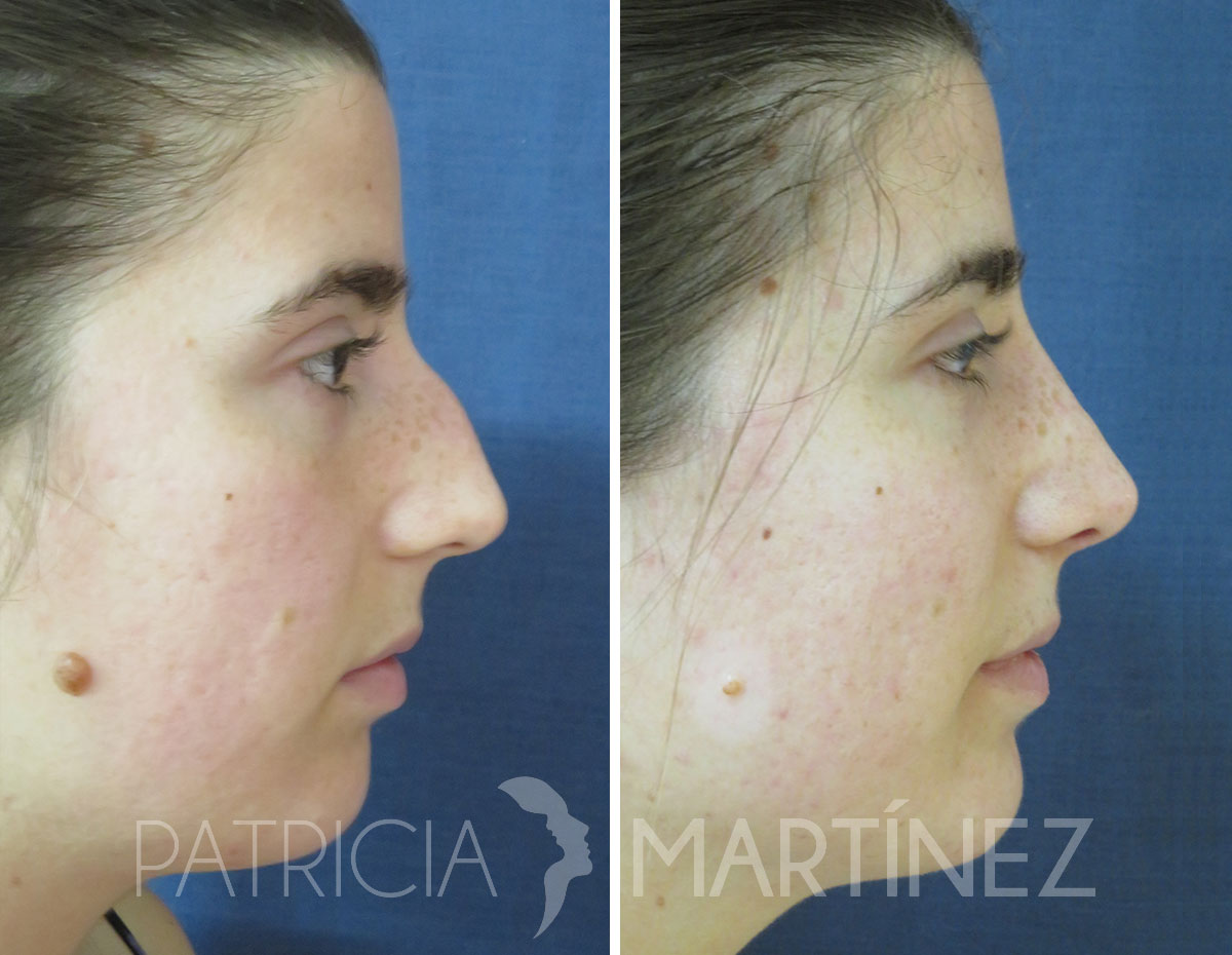 antes-despues-rinoplastia-01