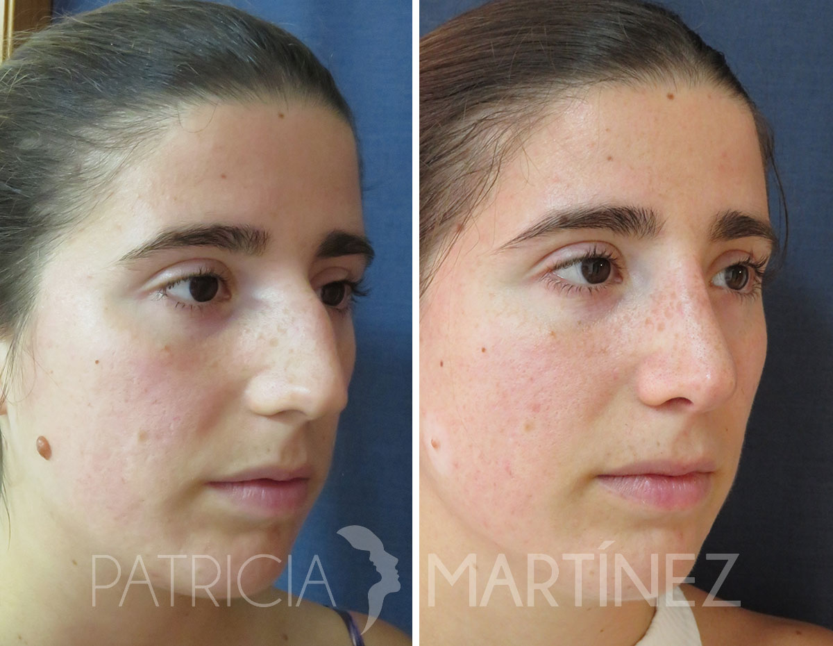 antes-despues-rinoplastia-02