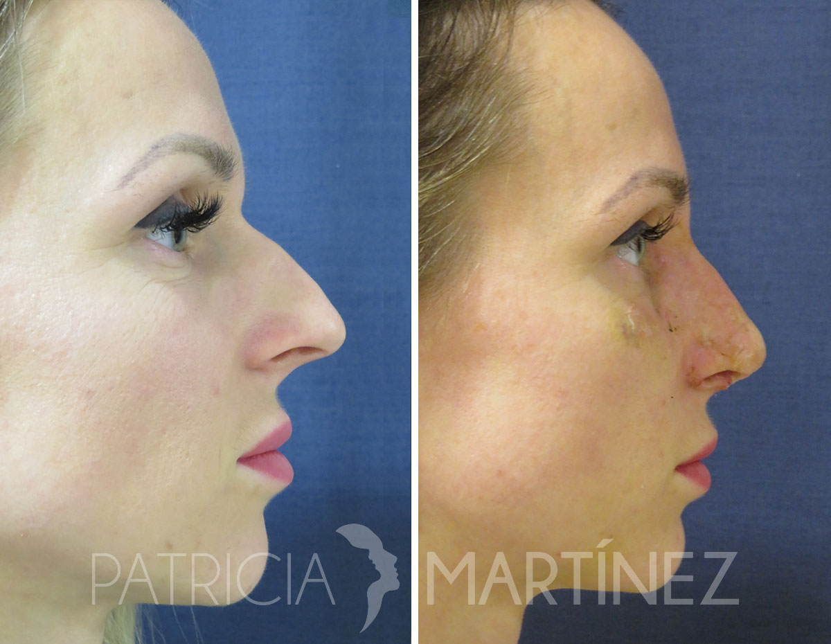 antes-despues-rinoplastia-03