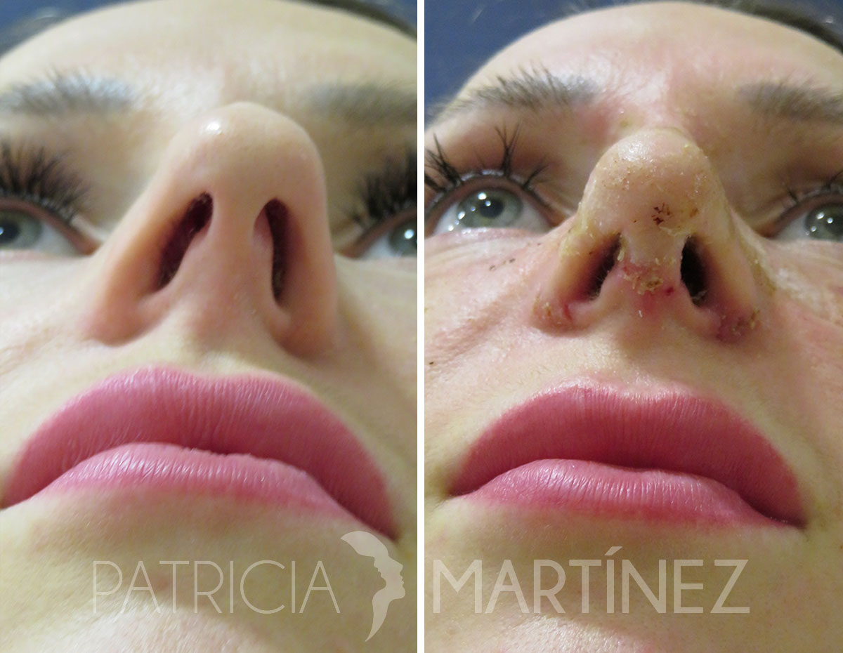 antes-despues-rinoplastia-05