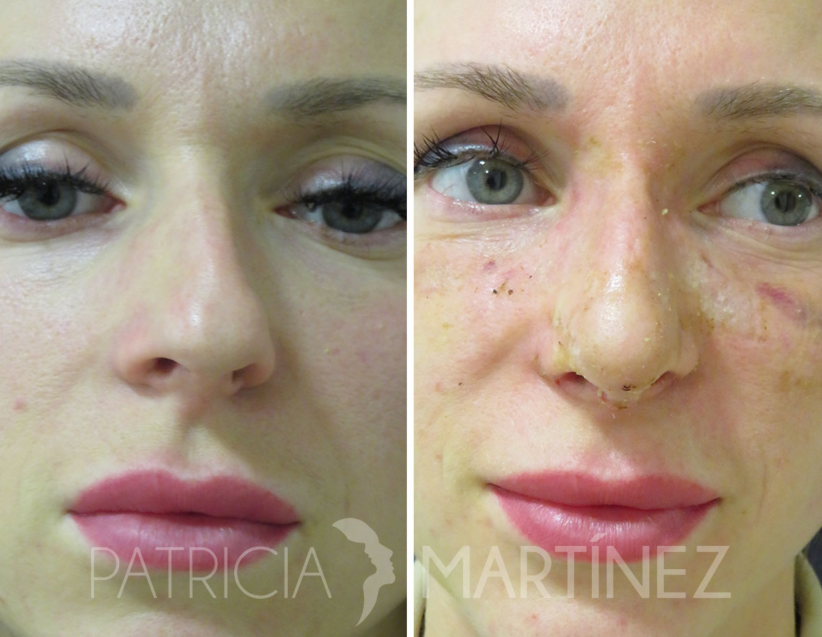 antes-despues-rinoplastia-06