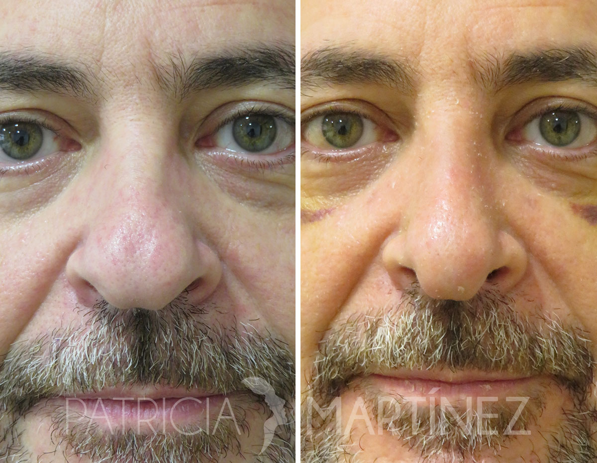 antes-despues-rinoplastia-07