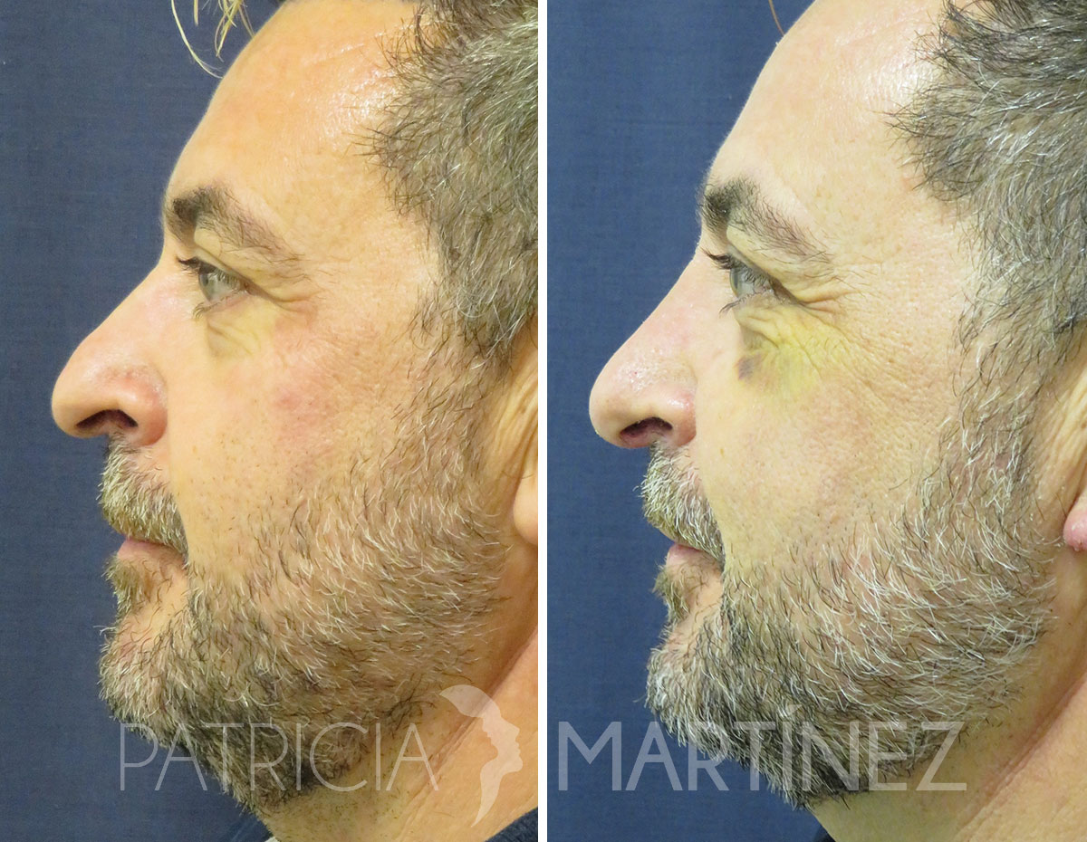 antes-despues-rinoplastia-08