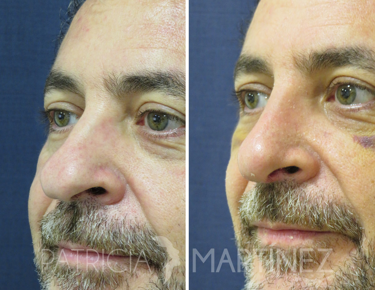 antes-despues-rinoplastia-09