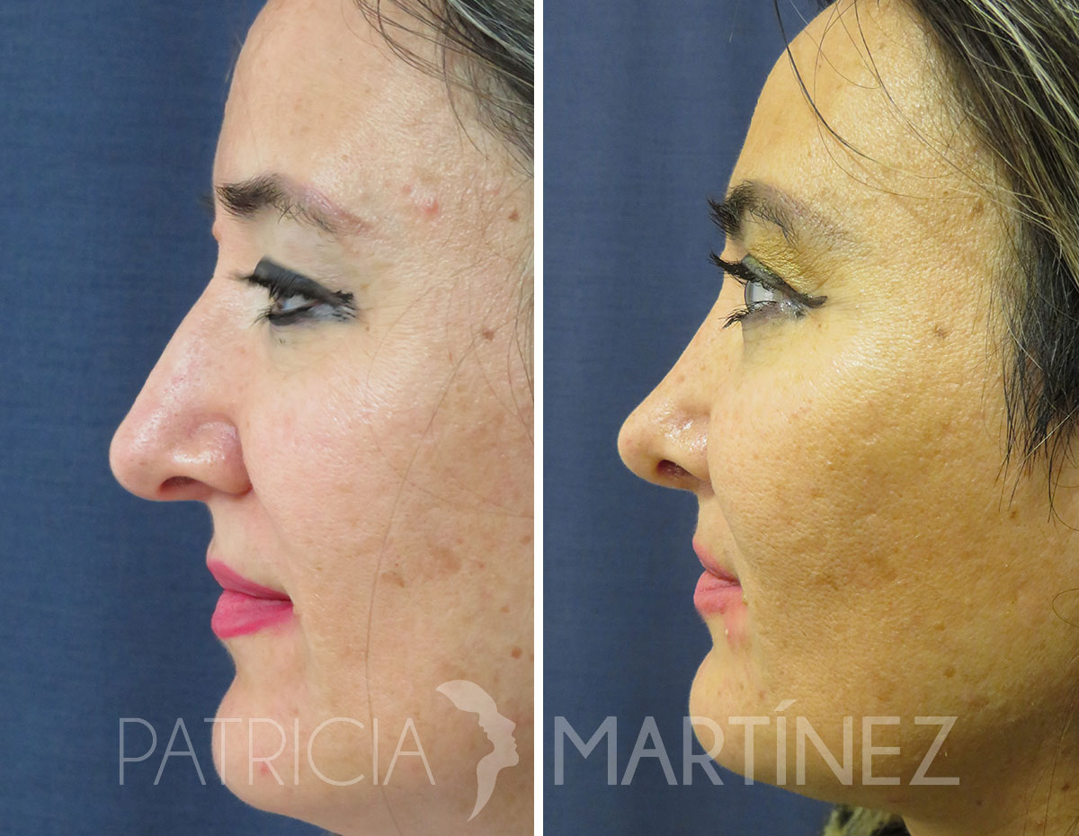 antes-despues-rinoplastia-10