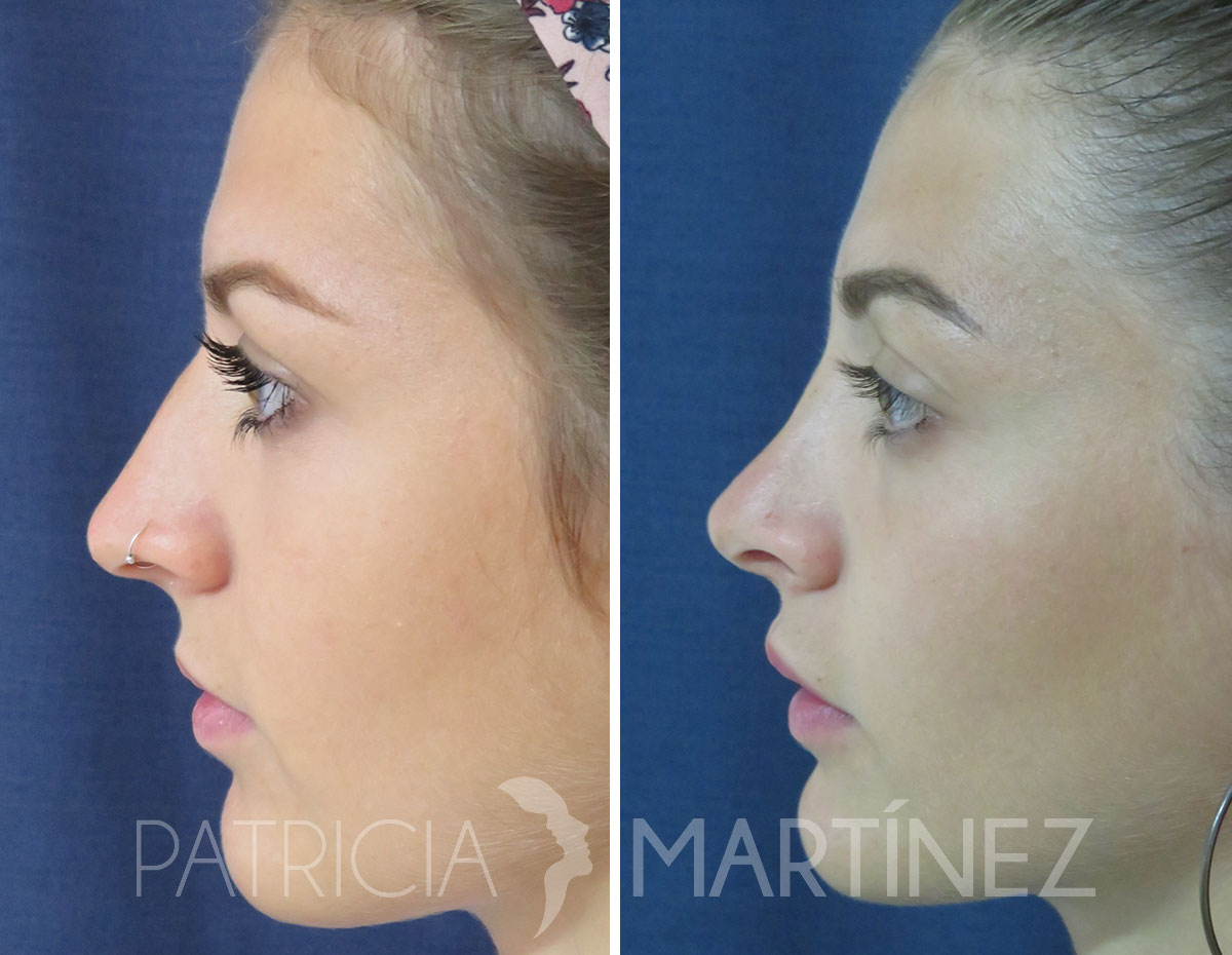 antes-despues-rinoplastia-11