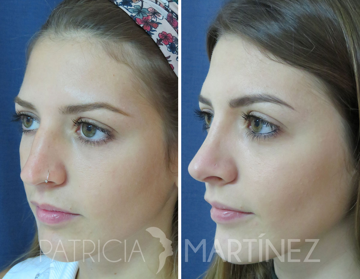 antes-despues-rinoplastia-12