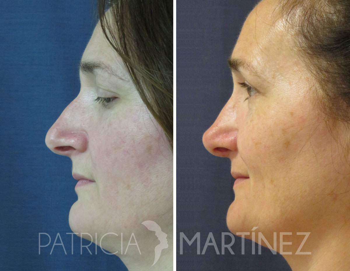 antes-despues-rinoplastia-13