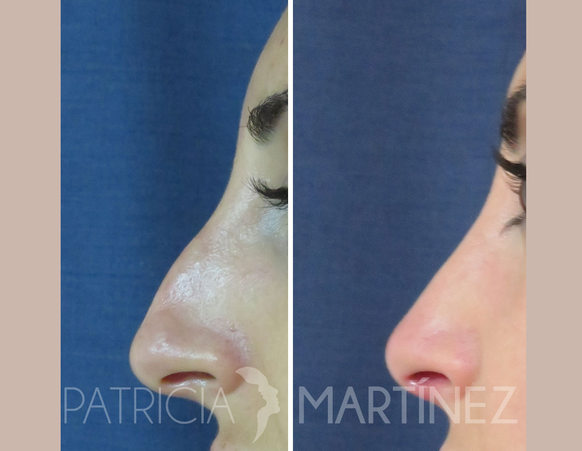 antes-despues-rinoplastia-14