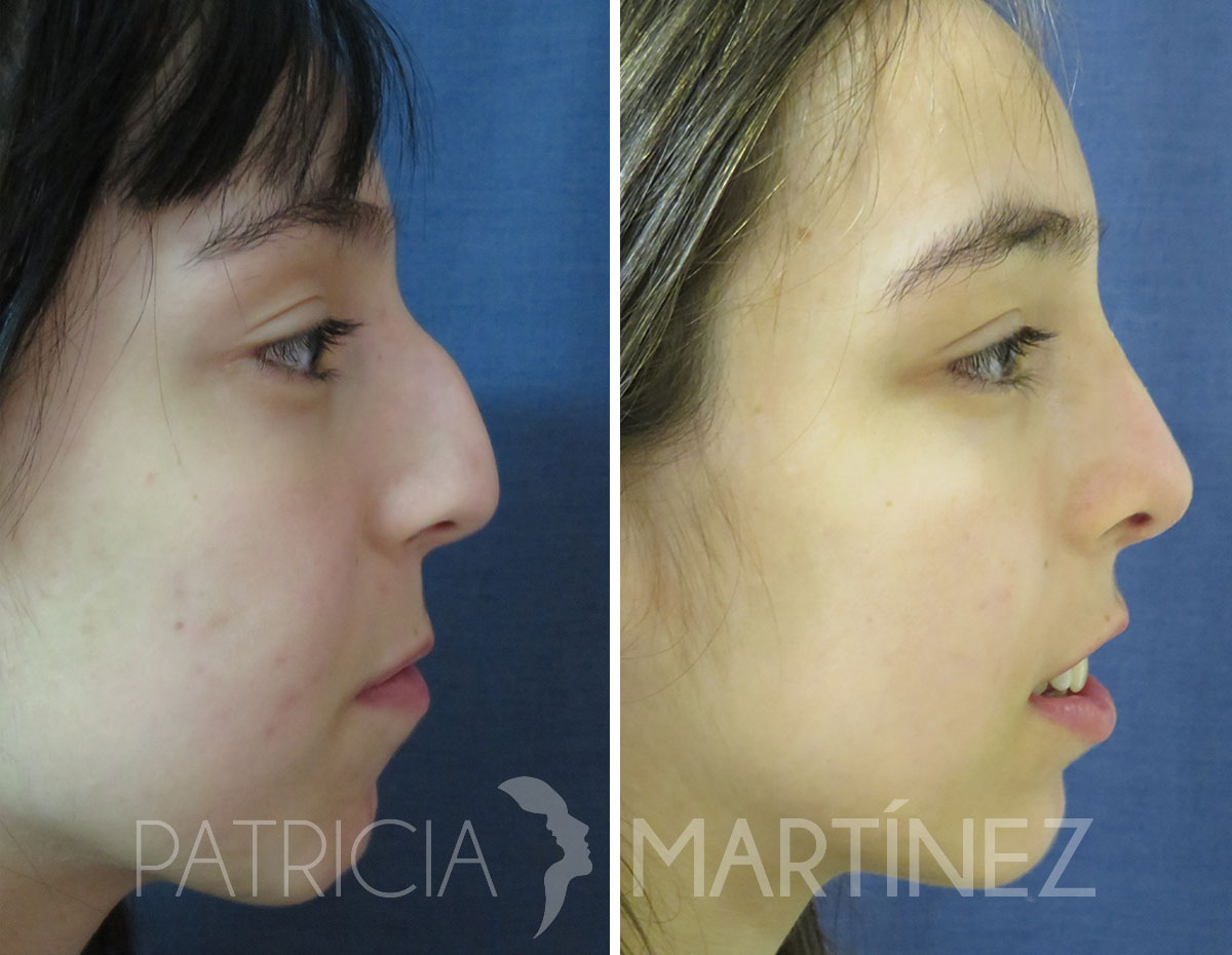 antes-despues-rinoplastia-15