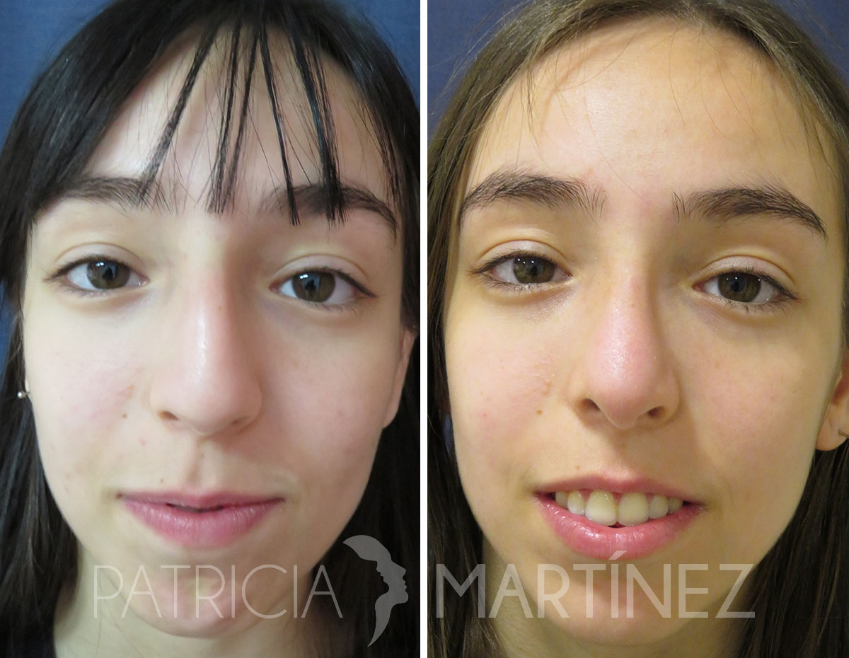 antes-despues-rinoplastia-16