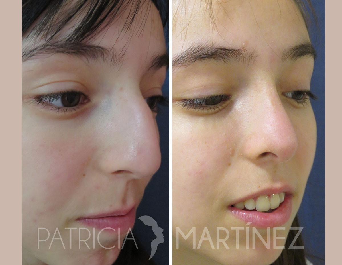 antes-despues-rinoplastia-17