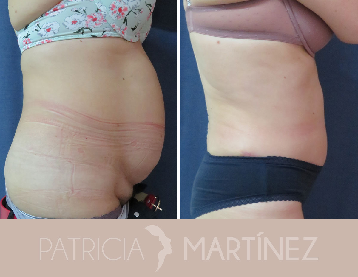 antes-despues-abdominoplastia-11