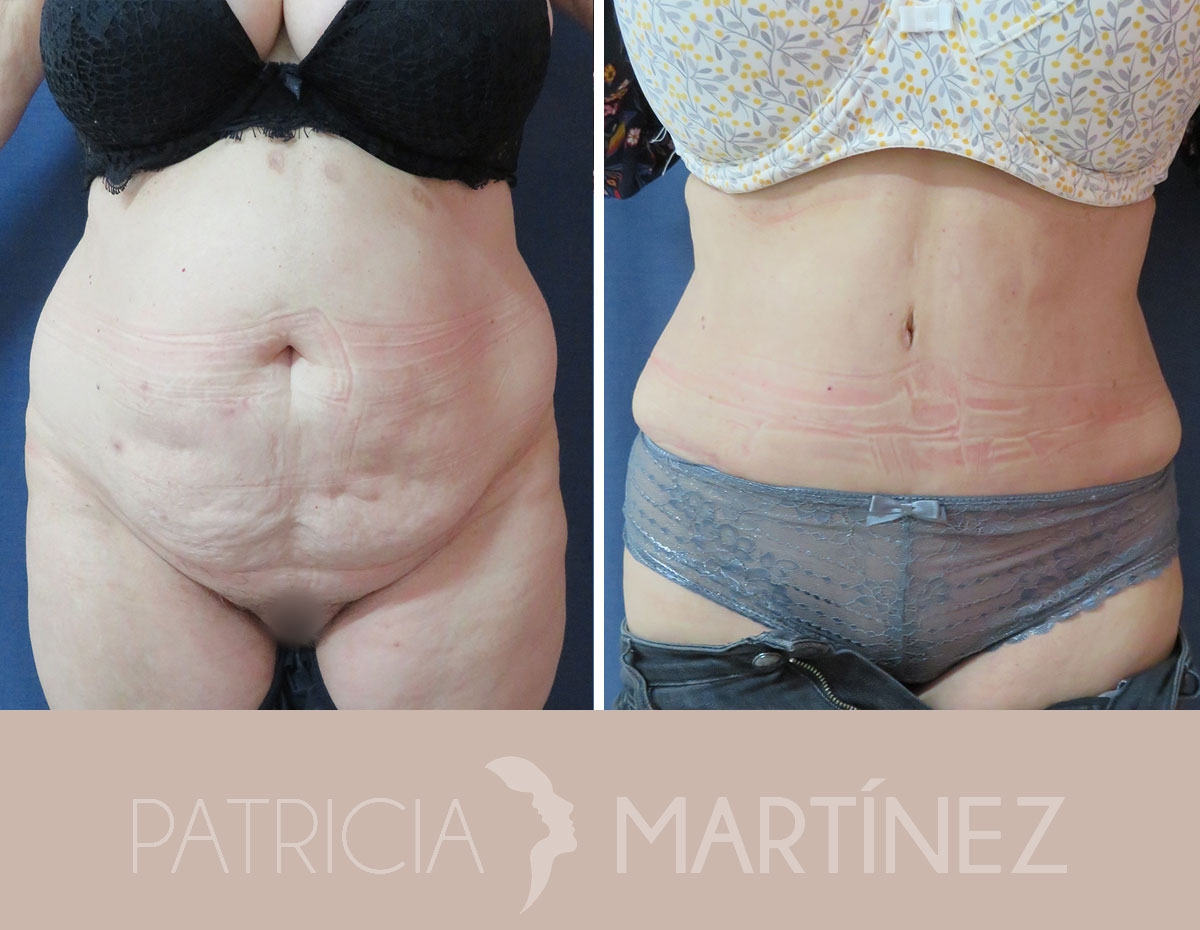 antes-despues-abdominoplastia-12