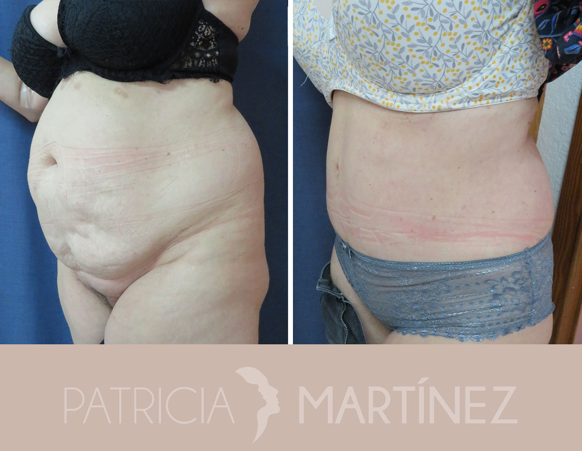 antes-despues-abdominoplastia-13