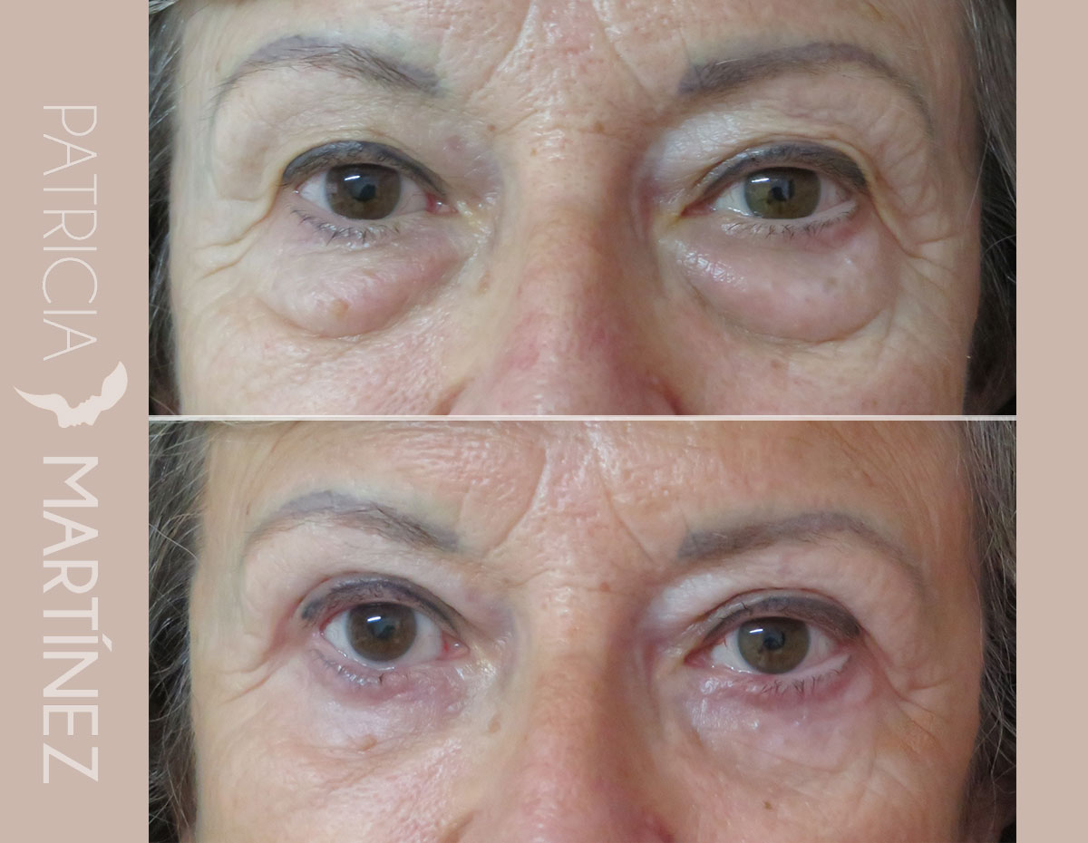 antes-despues-blefaroplastia-10